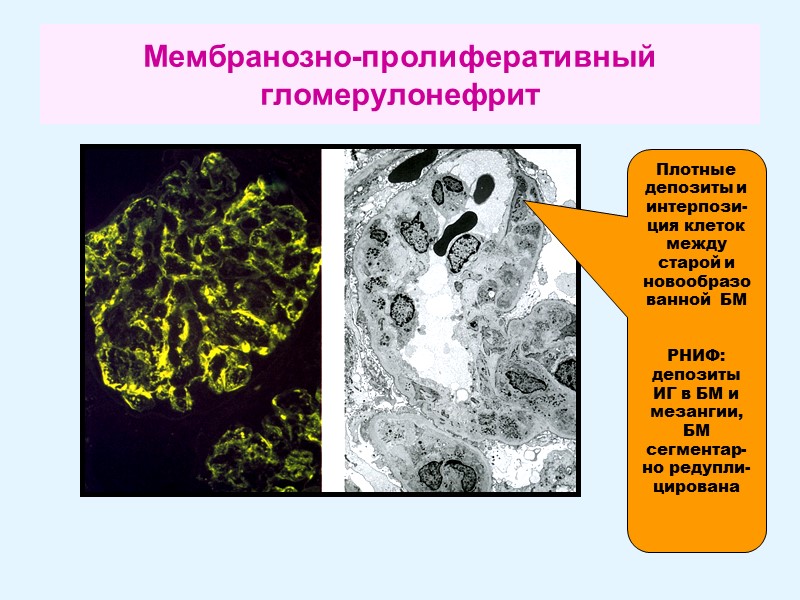 Мембранозно-пролиферативный  гломерулонефрит Плотные депозиты и интерпози-ция клеток между старой и новообразованной  БМ